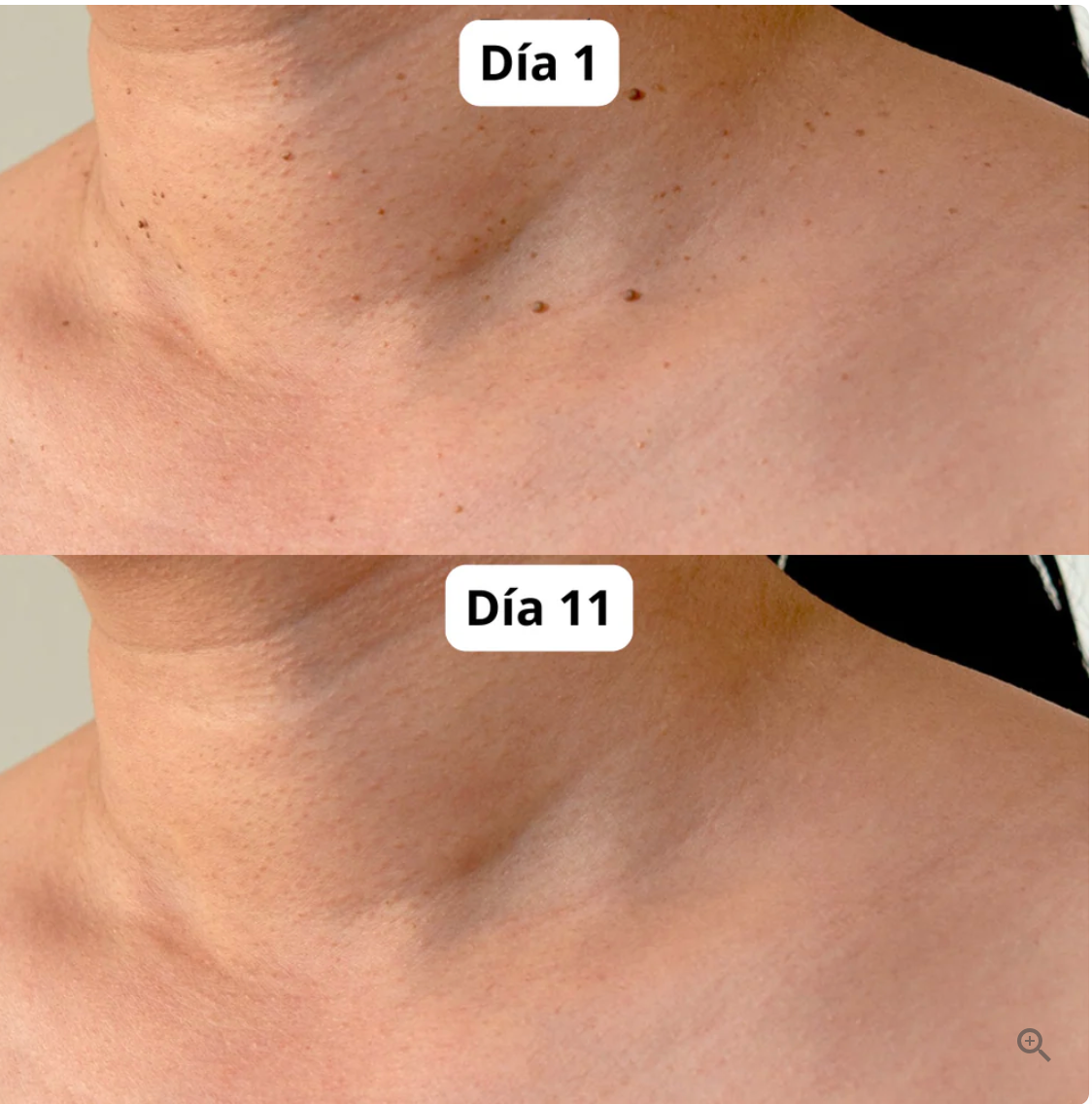 SkinClear Pro – Kit Eliminador de Verrugas