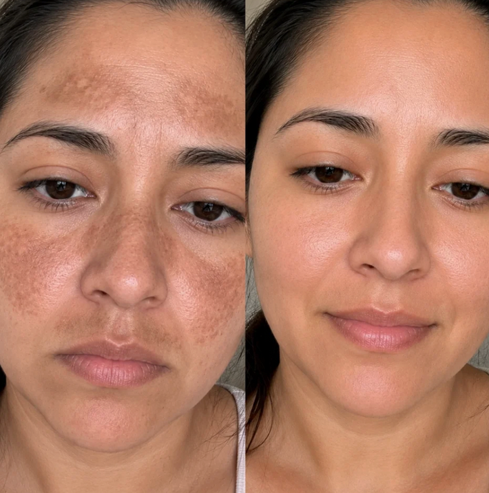 Resultado antes y después de Andrea