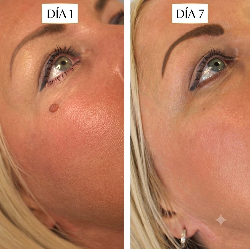 SkinClear Pro –  Kit Eliminador de Verrugas